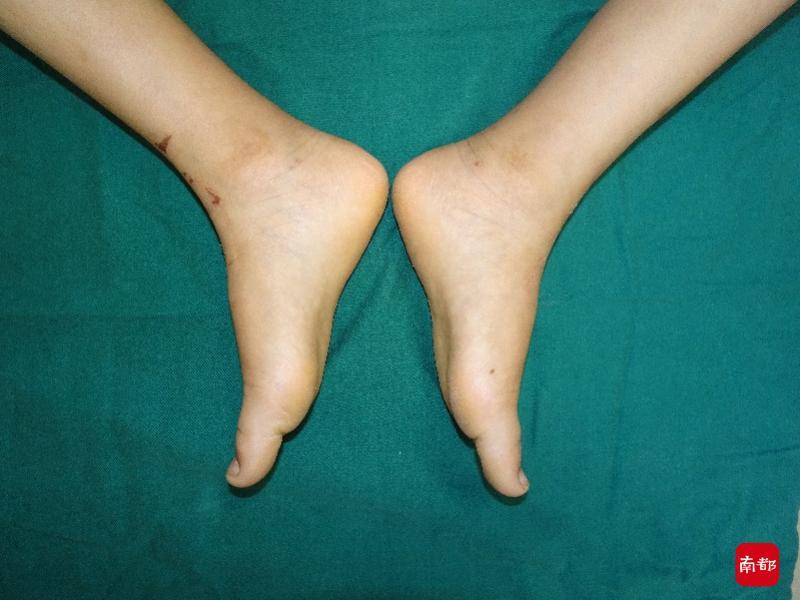 脚跟|6岁之后仍走路脚跟疼，多是需要极早干预的扁平足