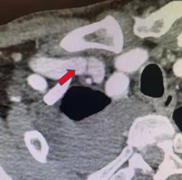 静脉|肾内科完成首例DSA下中心静脉狭窄球囊扩张术