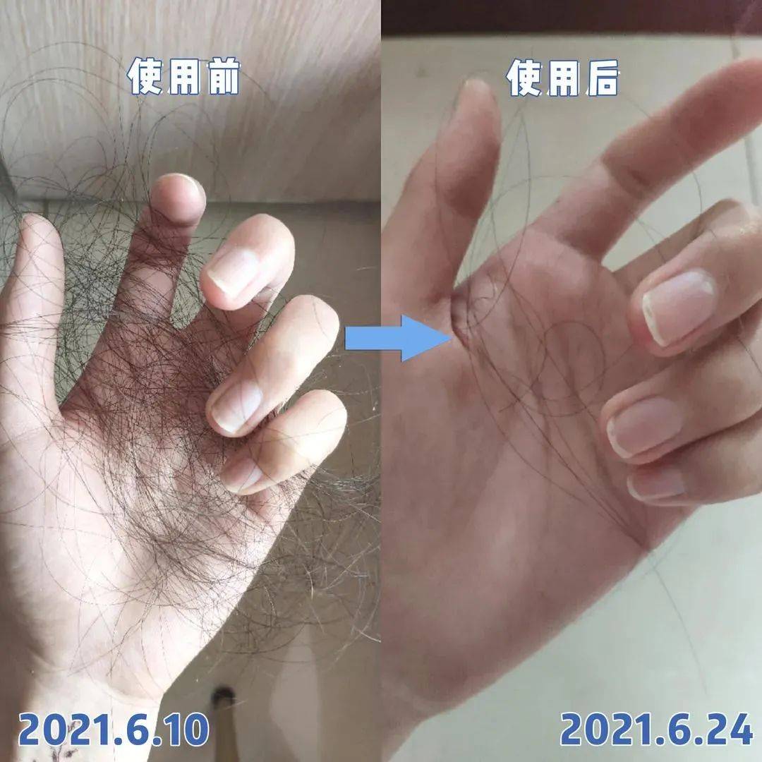 洗头|脱发、秃头，又丑又显老！这样做，头发浓密，更显年轻好气质