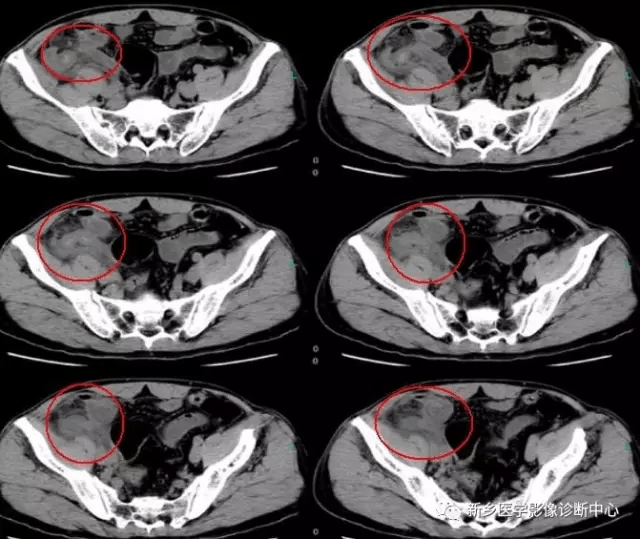 弹簧|图解21种腹部疼痛原因