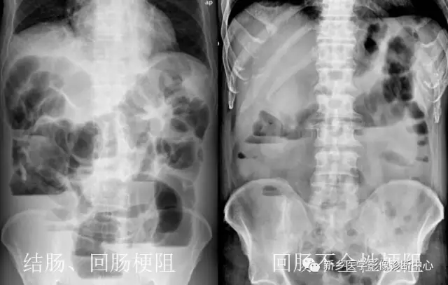 弹簧|图解21种腹部疼痛原因