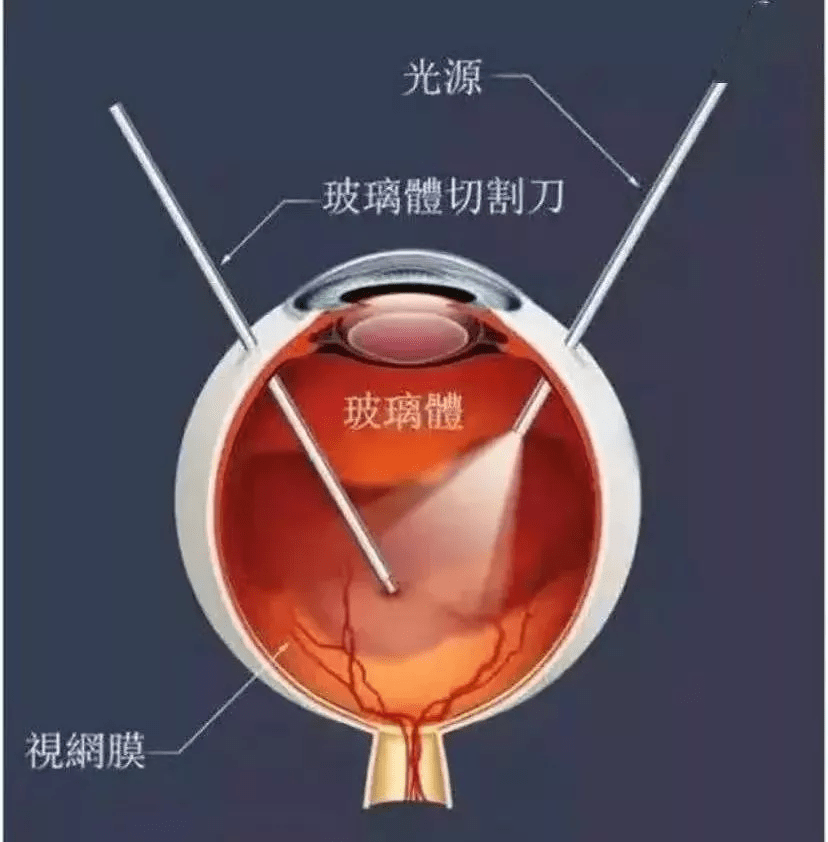安阳地区医院成功开展玻璃体切割术