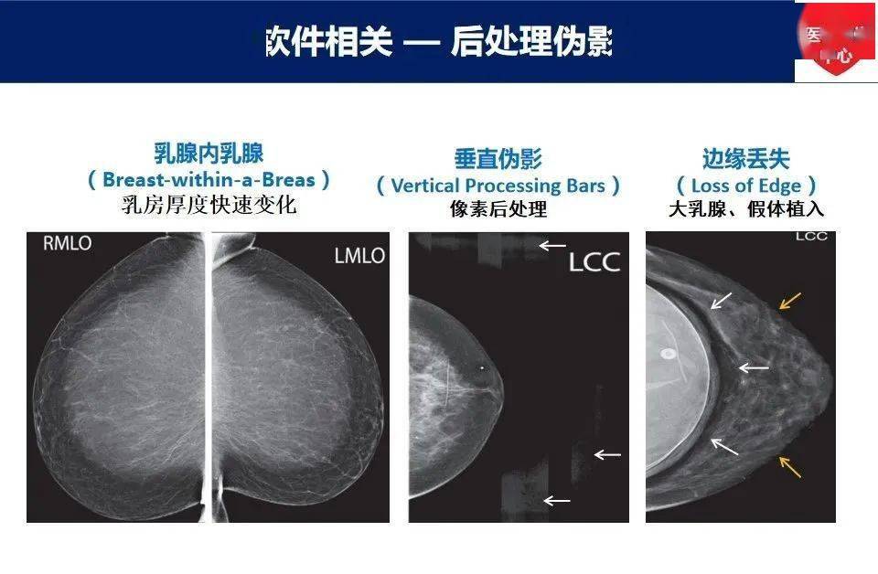 乳腺癌x線常見漏診及誤診