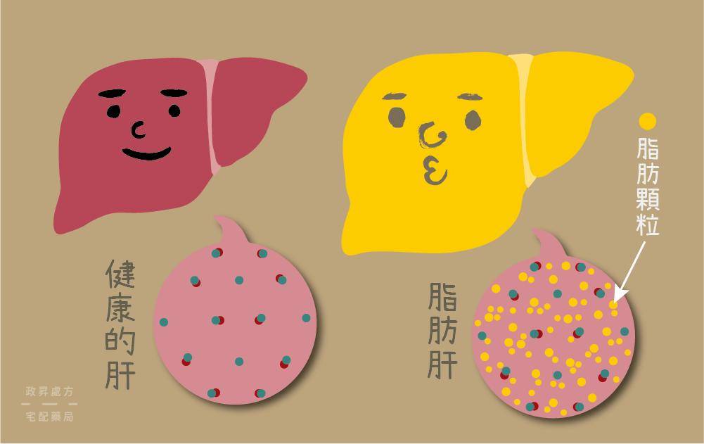 脂肪|爱吃油炸食物爱吃肉，12岁男孩超重30斤患脂肪肝