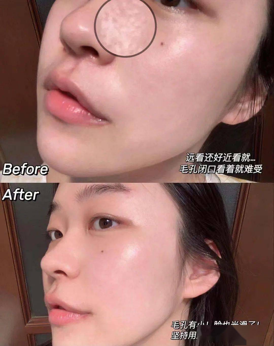 黑头|阿娇没骗我！2块钱敷一次酸，脸上“小疙瘩”竟被吞了！