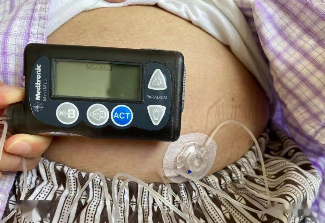 弘爱|小小“豆腐块〞，高血糖分分钟被搞定