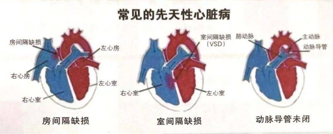 关于先天性心脏病的治疗