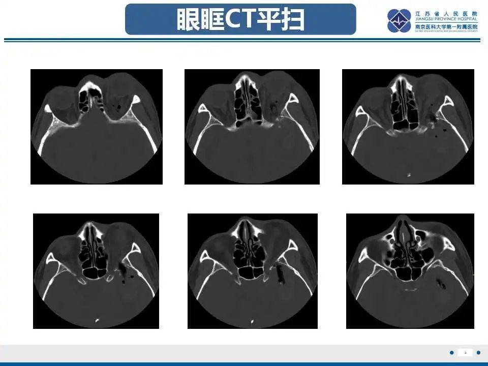 眼眶植物性異物的影像學診斷_解剖圖