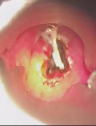 后壁|鱼刺卡喉用“老土方”？专家：不科学且危险！
