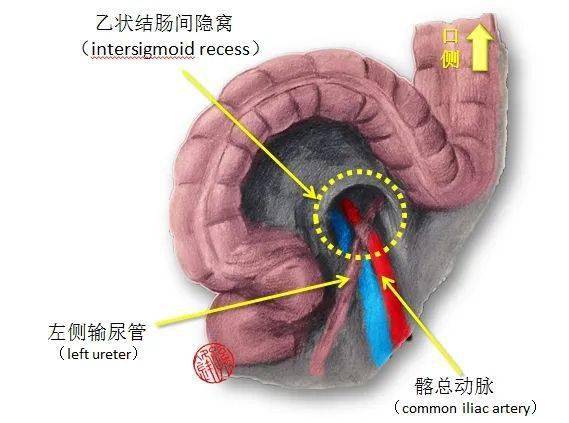 医学图说乙状结肠间隐窝的应用解剖学