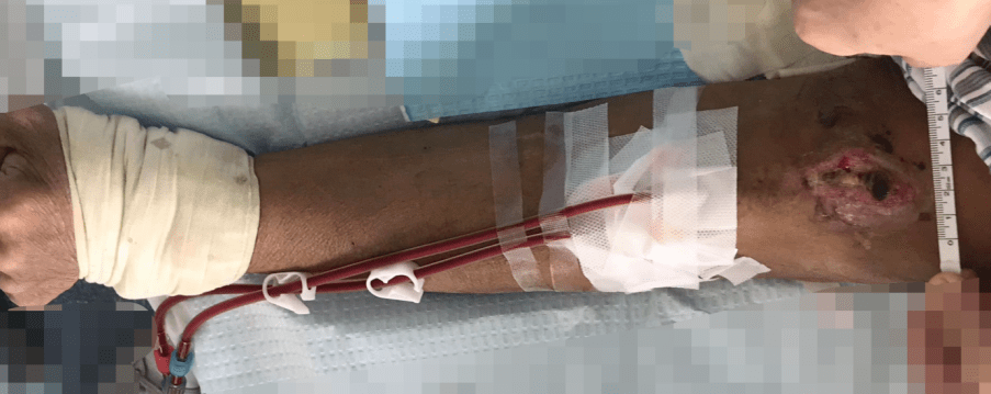 进行|【医患一家】精益求精,迎难而上,肾内科为血液透析患者重建“生命线”