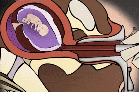 老公结扎2次妻子怀孕2次男人结扎就是太监了怎么还可能