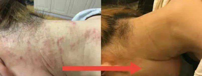 湿气|?湿疹反复发作该怎么摆脱？