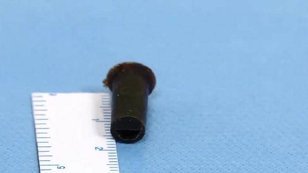 小林|广东小伙6岁吞了个哨子，因怕被家长骂瞒了20年！