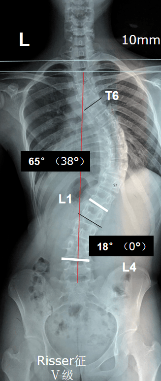 手术前x光片,可见明显脊柱侧弯手术后提早预防和筛查是防止青少年脊柱