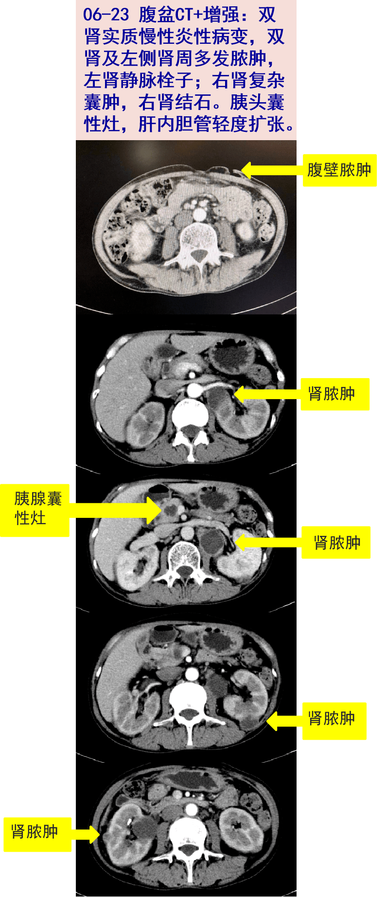 双肾及左侧肾周多发脓肿,左肾静脉栓子;右肾复杂囊肿,右肾结石