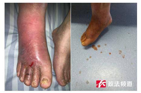 男子|长沙50岁男子足部红肿没重视，结果差点要截肢
