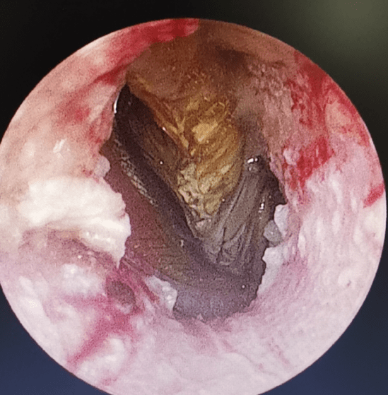 蟑螂|一觉醒来耳朵剧痛，原因竟是爬进这种昆虫