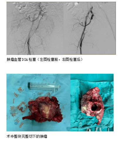 头条团队的力量市一院成功开展高难度半骨盆置换术