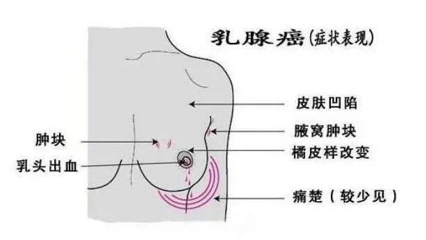 乳腺癌的症状 凹陷图片