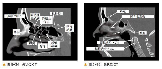 超清圖解鼻竇及顱底ct解剖