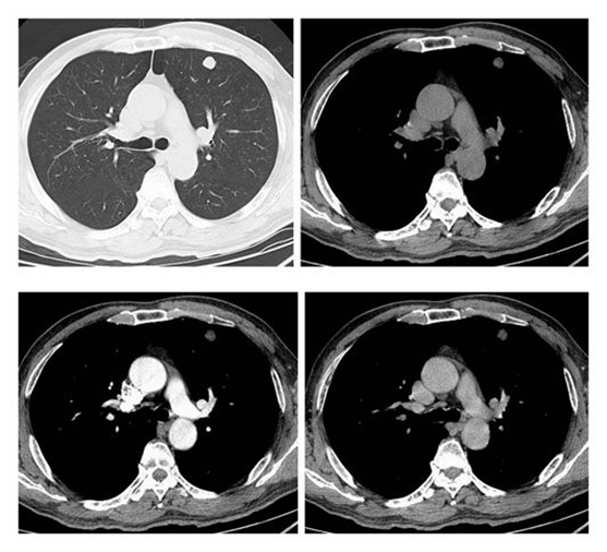 肺错构瘤影像图片
