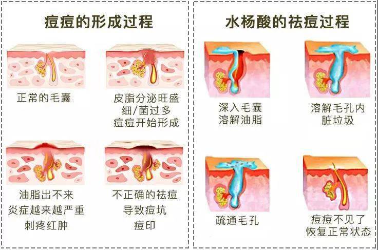 刷酸是什么意思图片 9bdbb386c861488b834af33014a94ba7.jpeg