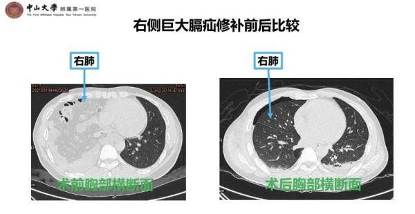 症状|内脏竟然会“跑路”？为了减掉肚腩，中年男子“用力过猛”后悲剧了…