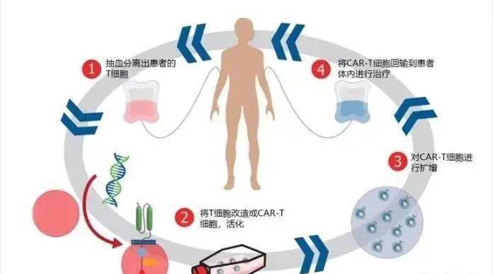 关注 Car T细胞疗法治愈hiv临床试验的新进展 病毒