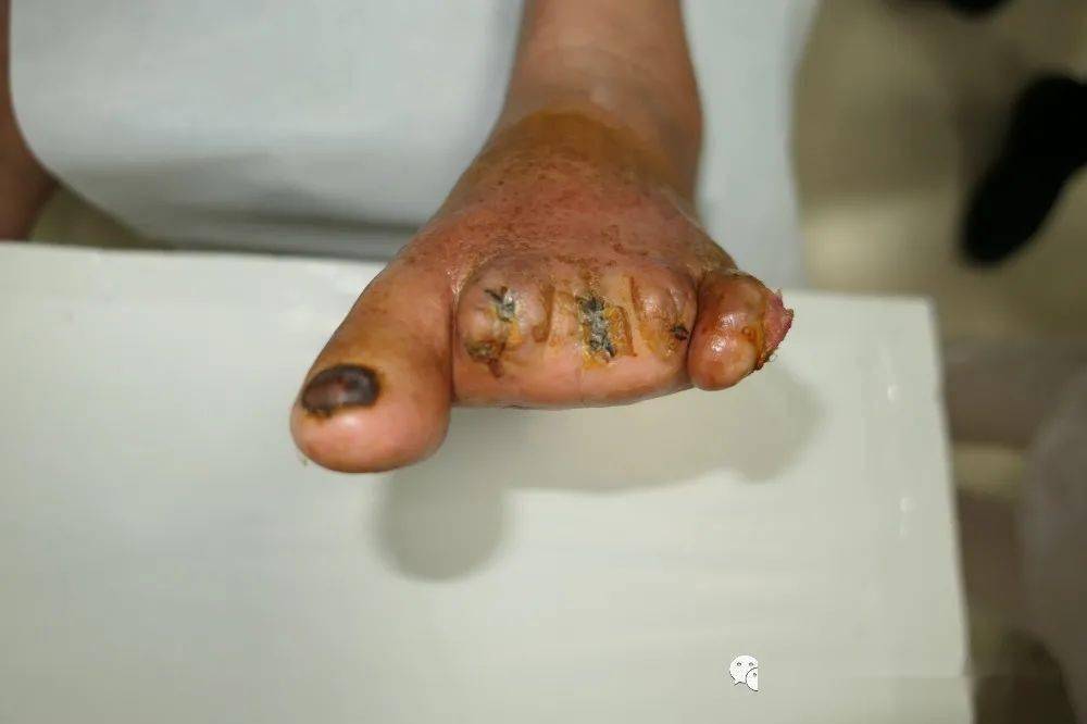 脚趾炭疽坏死图片图片