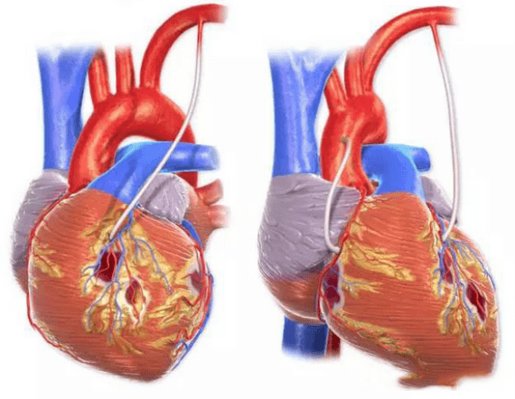 血管|全国科普日:医生靠什么评估冠心病