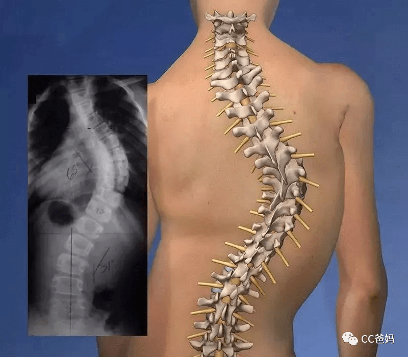 小孩脊椎骨弯曲图片图片