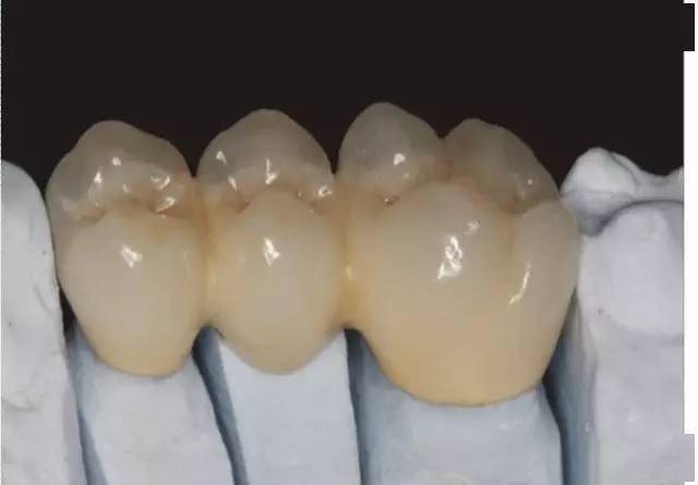 烤瓷牙与全瓷牙,应怎样选?