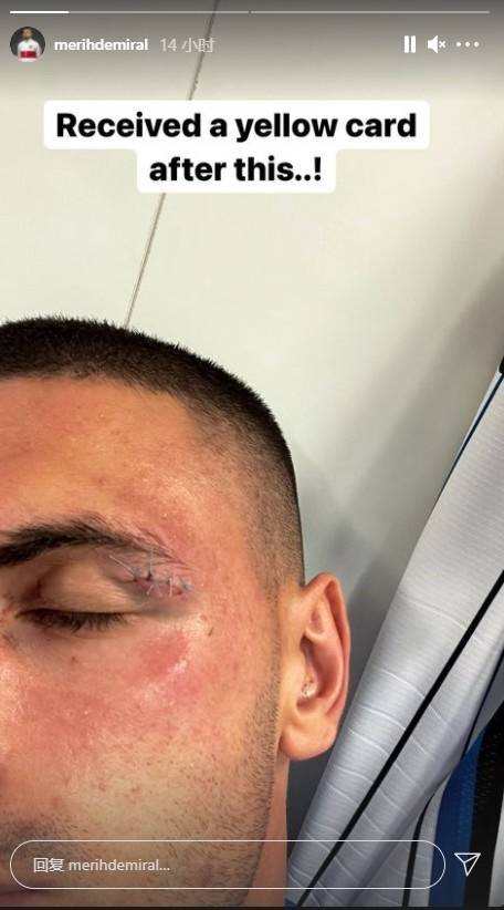 德米拉尔晒眉骨缝针照表达不满:被肘击之后我被出示了一张黄牌