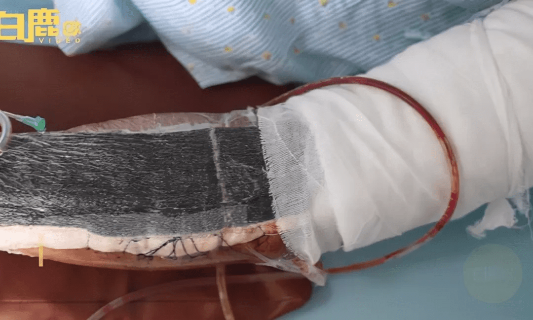 男子|男子被蚊子咬后发高烧险截肢，22天做了5场手术，医生紧急提醒