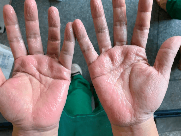 脸上深深的勒痕湿透的工作服发白起皱的双手是每一位"大白"脱下"战服"