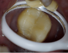 方脸|一口下去7000元没了！国字脸方脸很容易中招