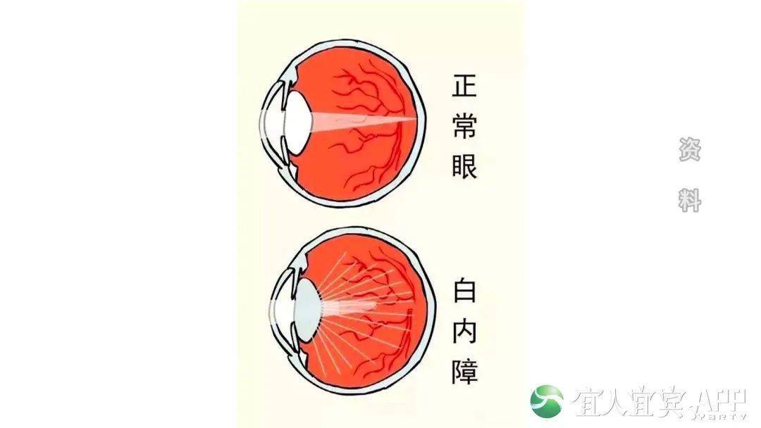 惊眼睛里竟然长出一层白膜原来是