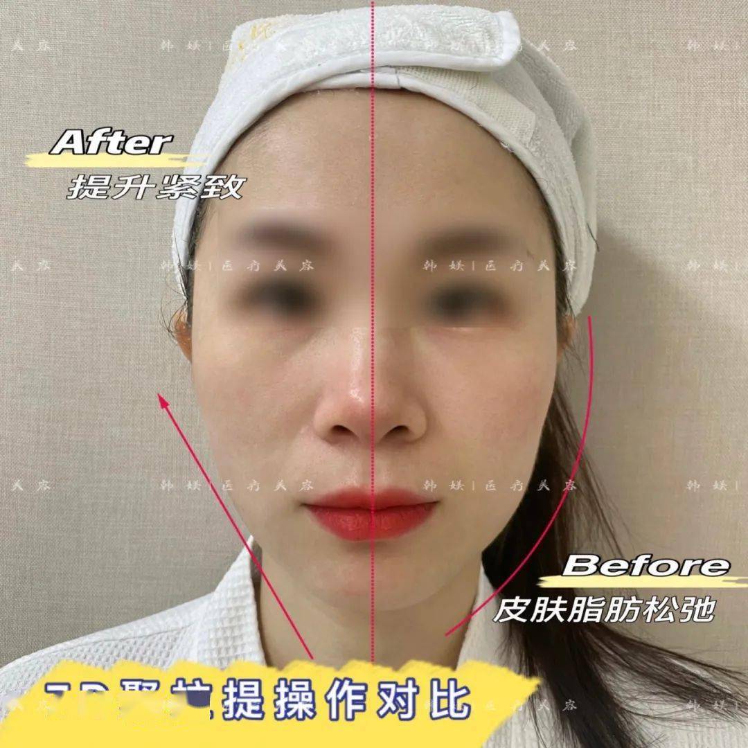 揭秘火爆揭阳人朋友圈的7d聚拉提到底能不能做