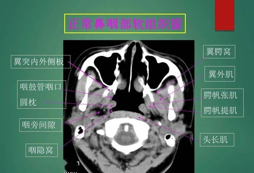 鼻部ct解剖结构图图片