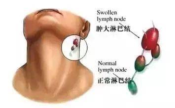 淋巴疏通什么原理_腋下淋巴疏通刮痧图解