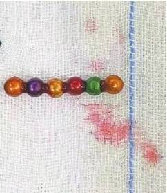 严重|1岁幼儿误吞11颗巴克球致肠穿孔