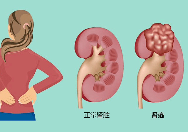 肾癌课程第二弹