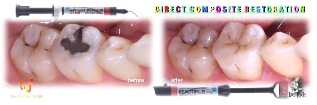 松风病例秀袁伟双色法窝沟自然染色流动树脂膏体树脂双剑合璧后牙充填