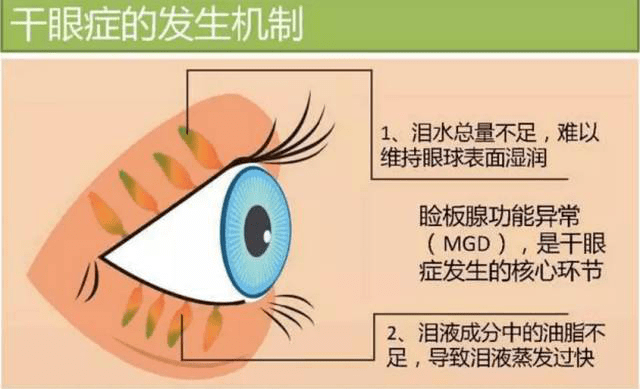 关于白内障术后干眼 你想知道的都在这里 眼睛