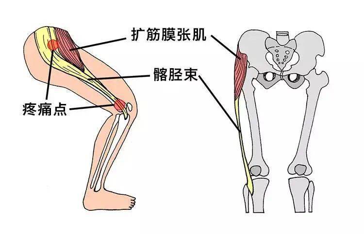 当臀中肌力量薄弱,阔筋膜张肌可以在一定程度上弥补臀中肌力量不足,髂