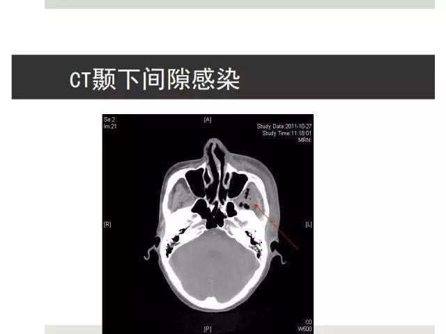口腔颌面部间隙感染多图