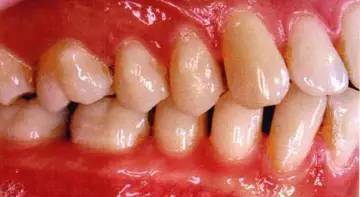 邻面去釉常见问题