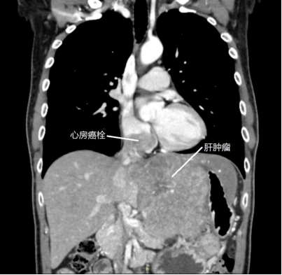 静脉|癌栓沿着静脉进入心房形势危殆，两大手术团队联手“拆弹”
