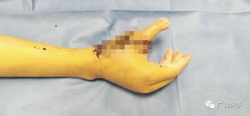 脚趾|“移花接木”成功了！脚趾移植变拇指